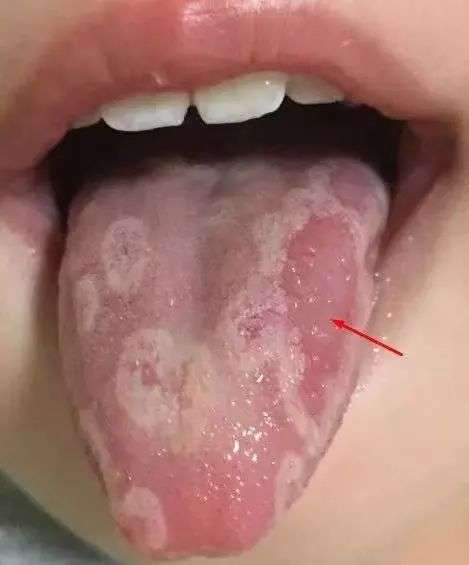 舌苔剥落